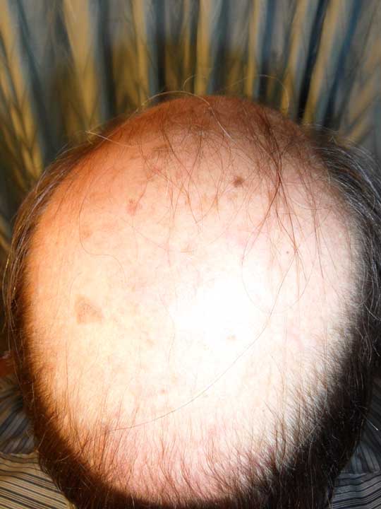 Alopecia hombre