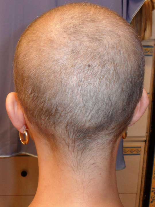 Alopecia mujer